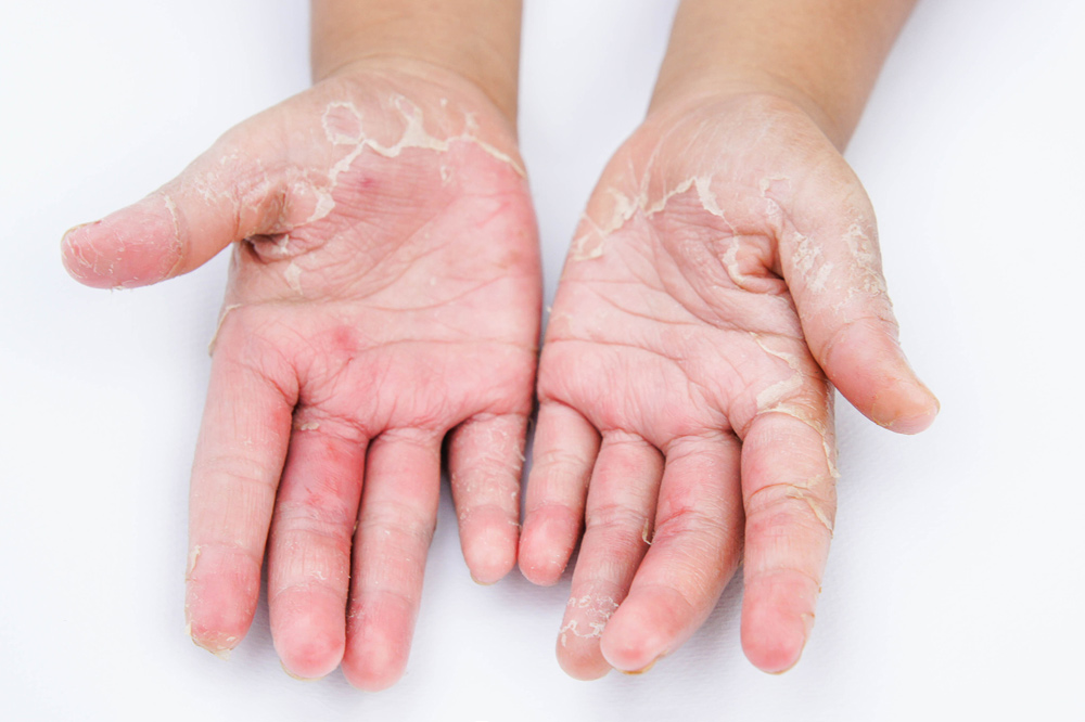 dermatitis