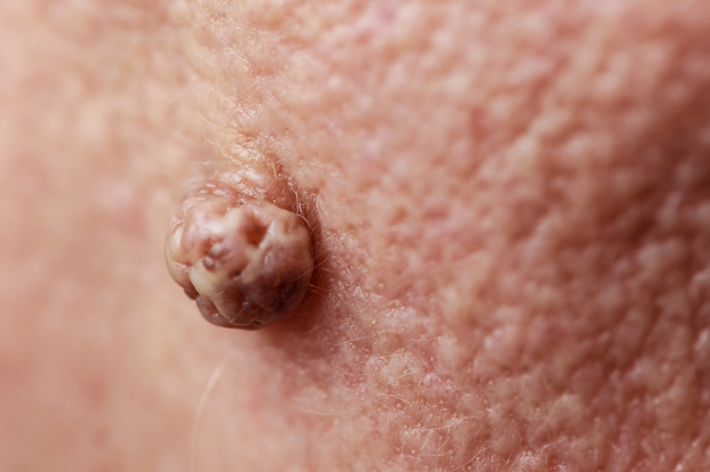 fibrom