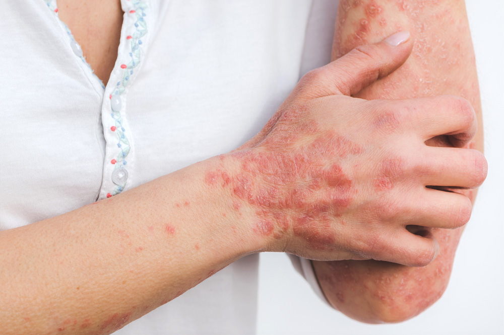 psoriasis